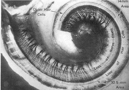 Figure 3. Electron micrograph of a portion of the spiral curve of the human cochlea revealing a total obliteration of the outer hair cells and their accompanying nerve fibers following occupational noise exposure.